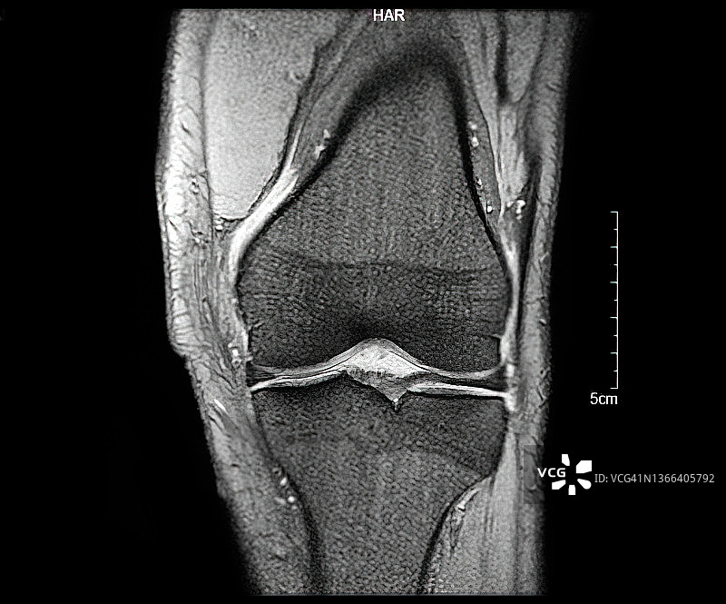 膝盖磁共振成像图片素材