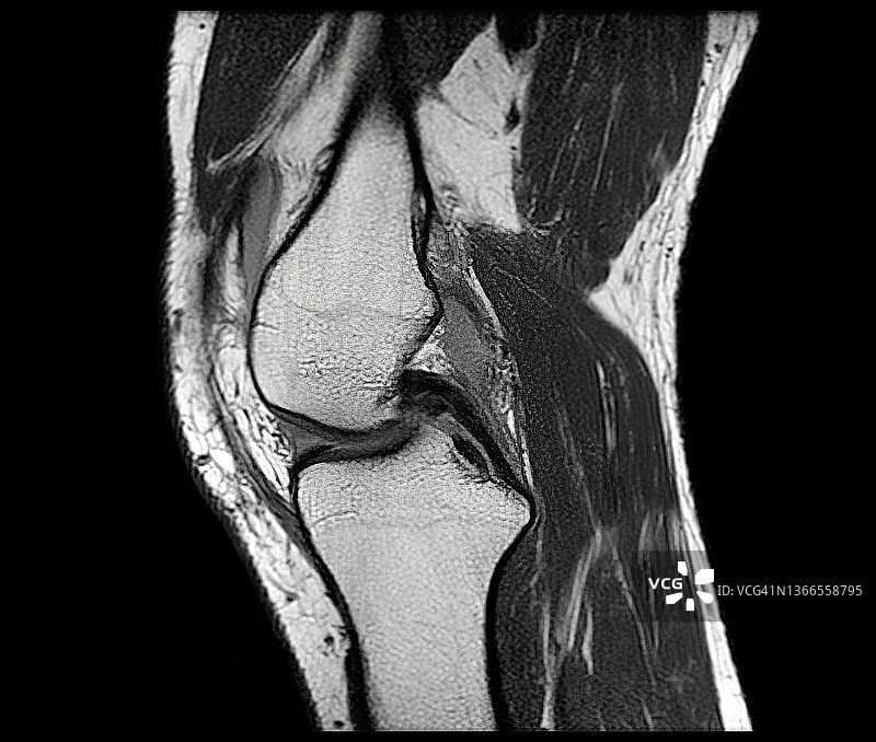 膝盖磁共振成像（MRI），（膝盖扭伤）图片素材