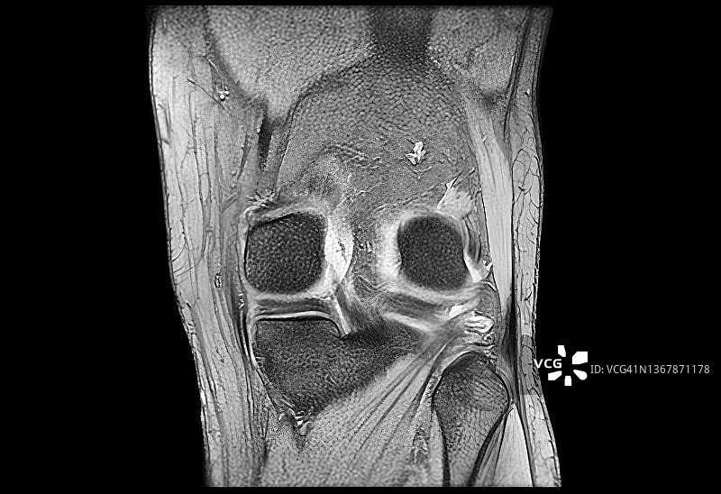 膝盖磁共振成像图片素材