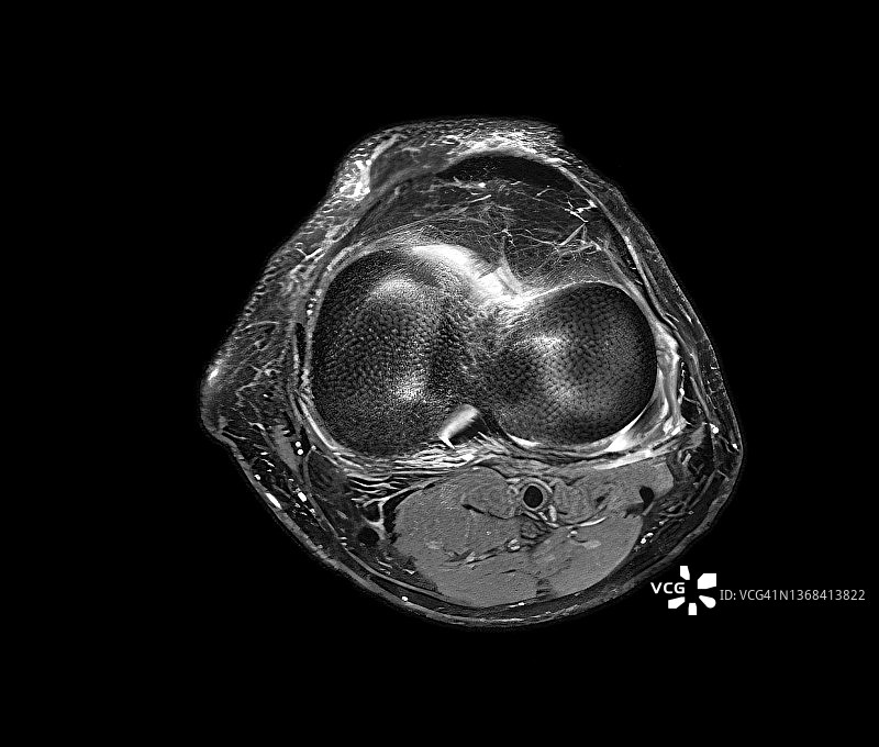 膝盖磁共振成像图片素材