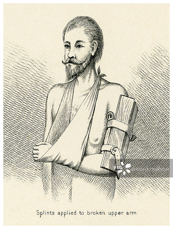 古代雕刻图：急救，骨折的临时处理 - 应用于手臂骨折的夹板图片素材