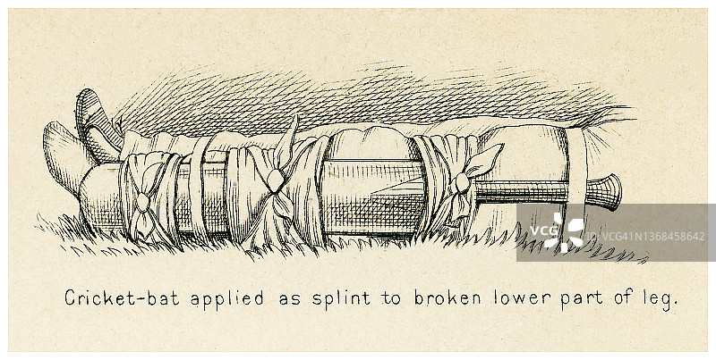 急救古版画：骨折的临时处理 - 用板球拍作为夹板固定于小腿骨折部位图片素材