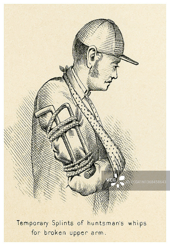 急救：猎人鞭子临时夹板，用于固定骨折的上臂图片素材