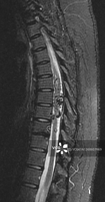 脊髓动静脉畸形（AVM）MRI矢状位视图图片素材