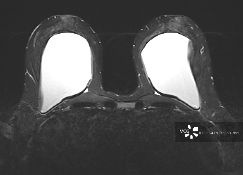 乳房植入物核磁共振成像图片素材