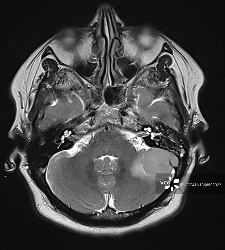 左侧后颅窝脑膜瘤，MRI T2轴位图像图片素材