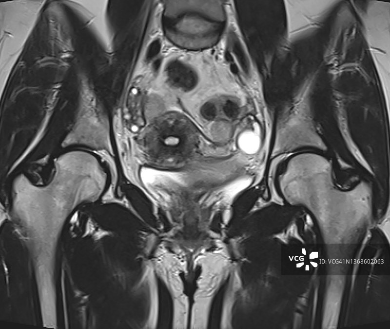 女性髋部的磁共振成像图片素材