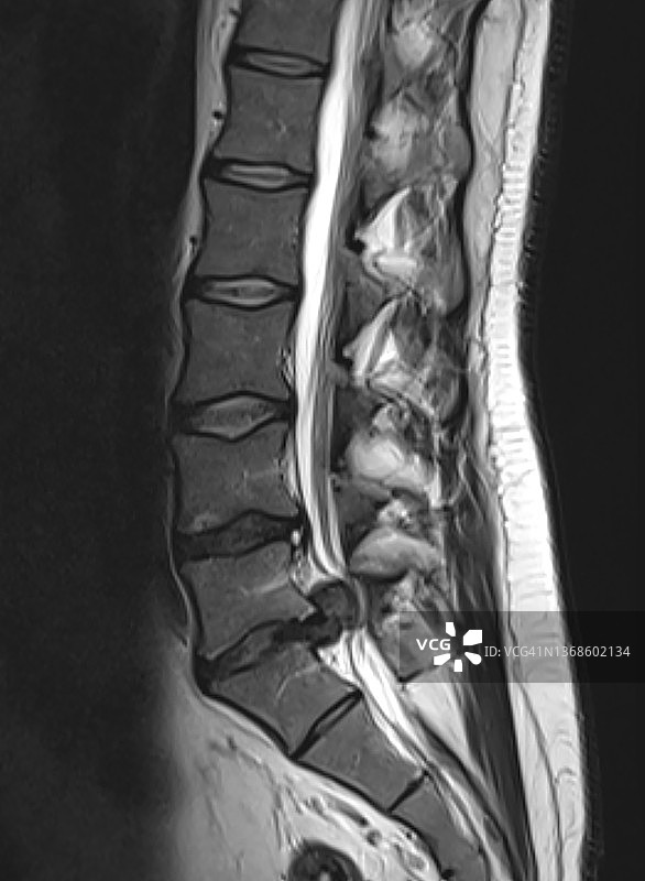 L5-S1腰椎间盘突出，MRI矢状位T2图像图片素材