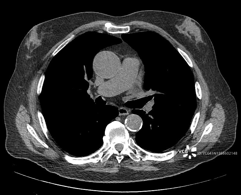 中年成人胸部CT扫描显示的双侧男性乳房发育图片素材