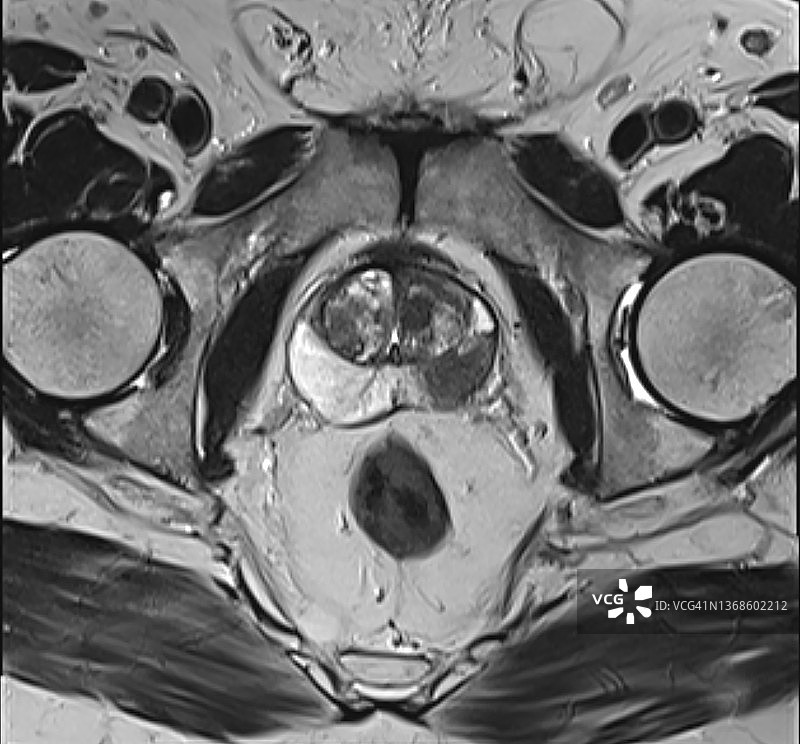 前列腺癌外周带，MRI轴位T2图像图片素材