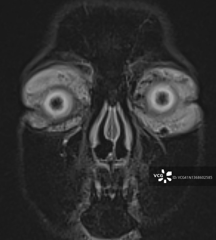 核磁共振图像：眼眶伯基特淋巴瘤冠状位影像图片素材
