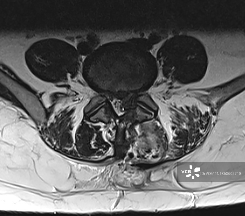 腰椎间盘切除术后复发，磁共振成像MRI图片素材