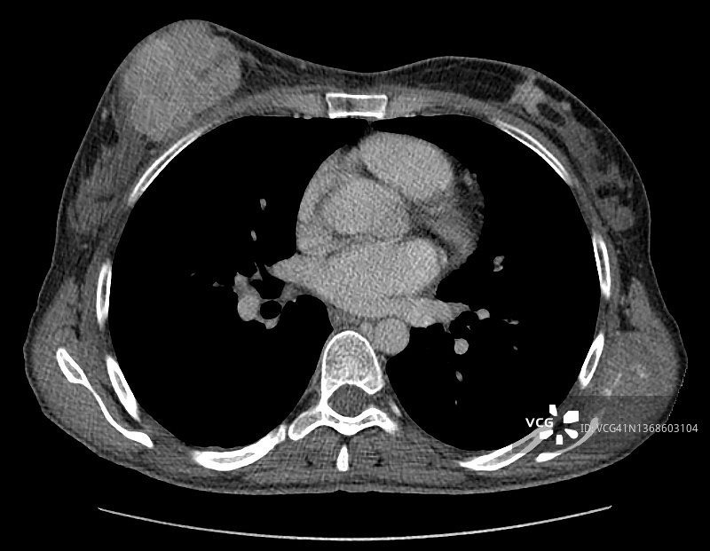 老年女性双侧乳腺肿瘤的CT图像，轴位增强图片素材