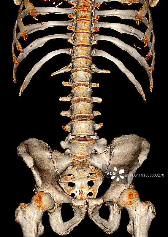 3D CT重建显示的腰骶椎移行椎（LSTV）图片素材