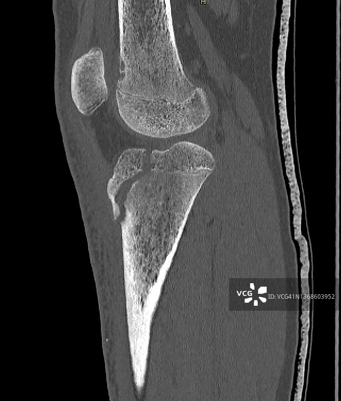 CT矢状重建显示的胫骨平台骨折图片素材