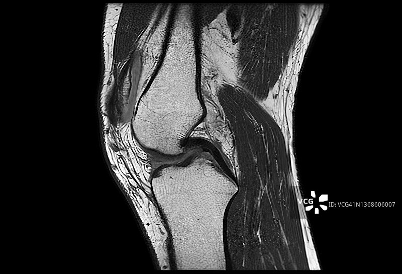 膝盖磁共振成像图片素材