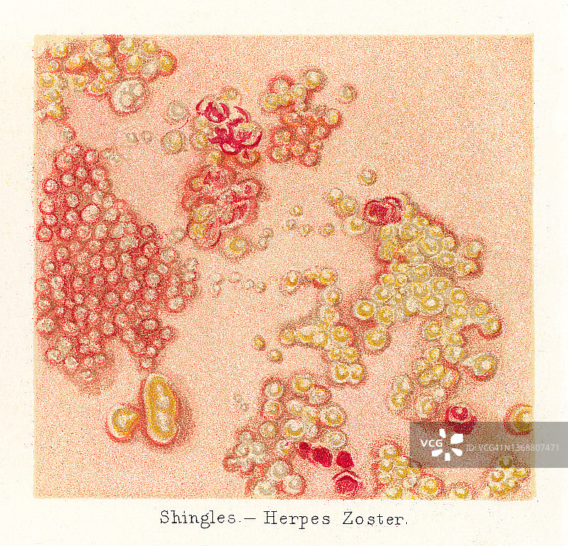 老式彩色石印插图：皮肤病 - 带状疱疹图片素材