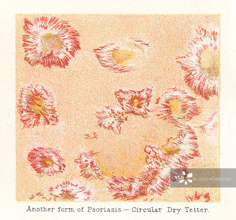 皮肤疾病旧版彩石版画：寻常型银屑病图片素材