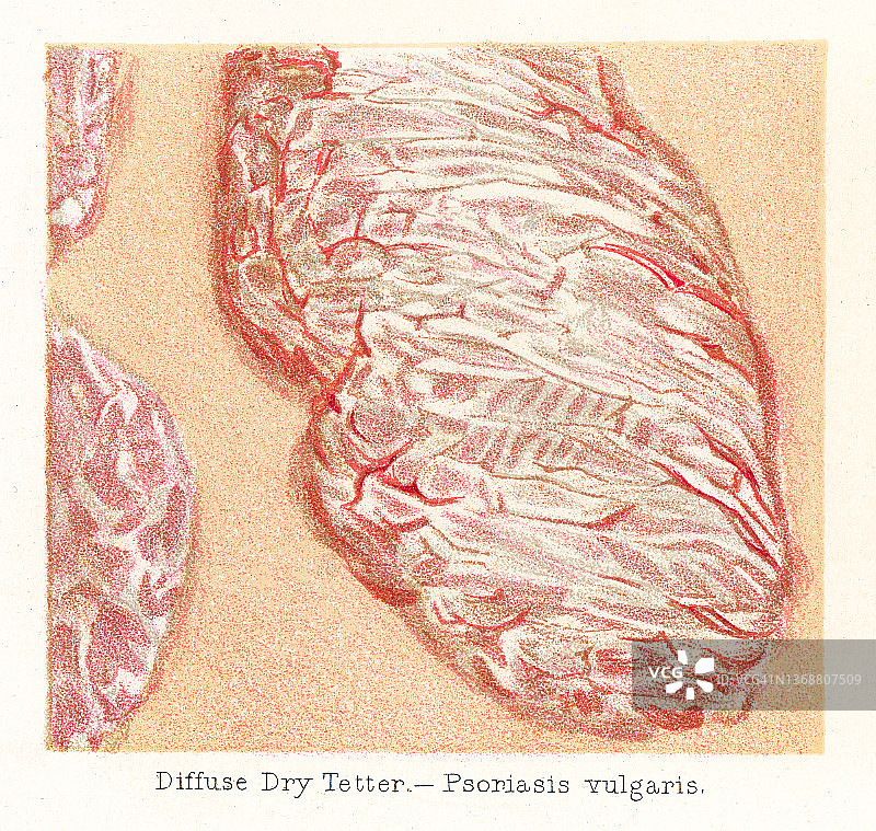 皮肤疾病旧版彩石版画：寻常型银屑病图片素材