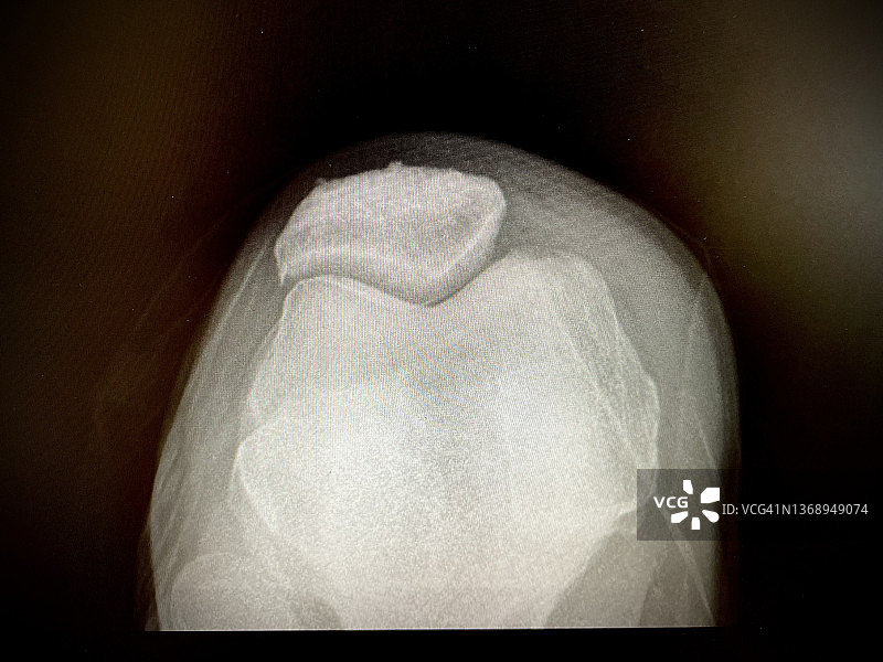 男性膝盖的X光片图片素材