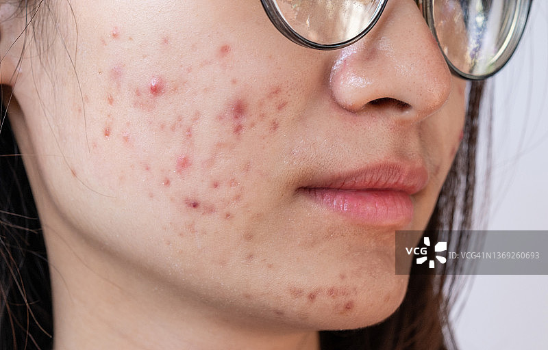 面部痤疮问题：女子面部特写图片素材