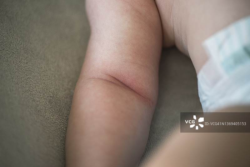 患有皮疹的宝宝图片素材