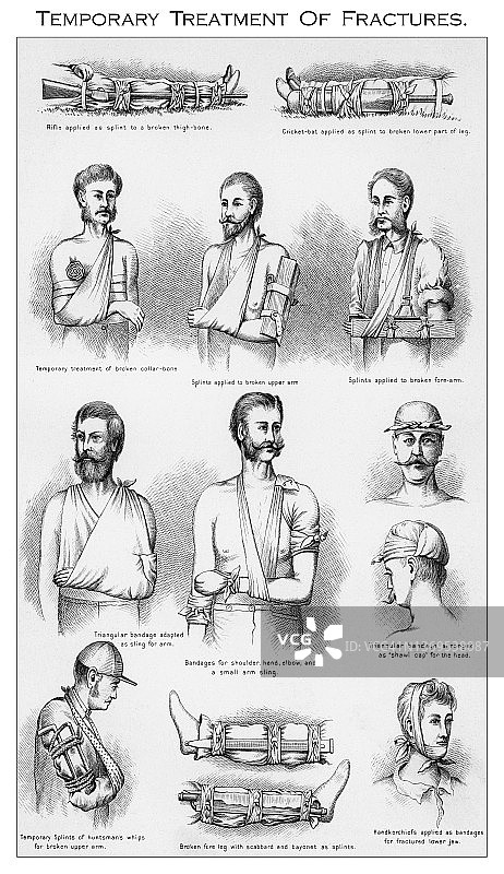 急救：骨折的临时处理古老版画插图图片素材