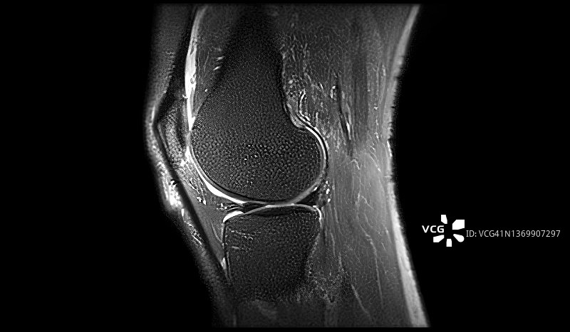 膝盖磁共振成像图片素材