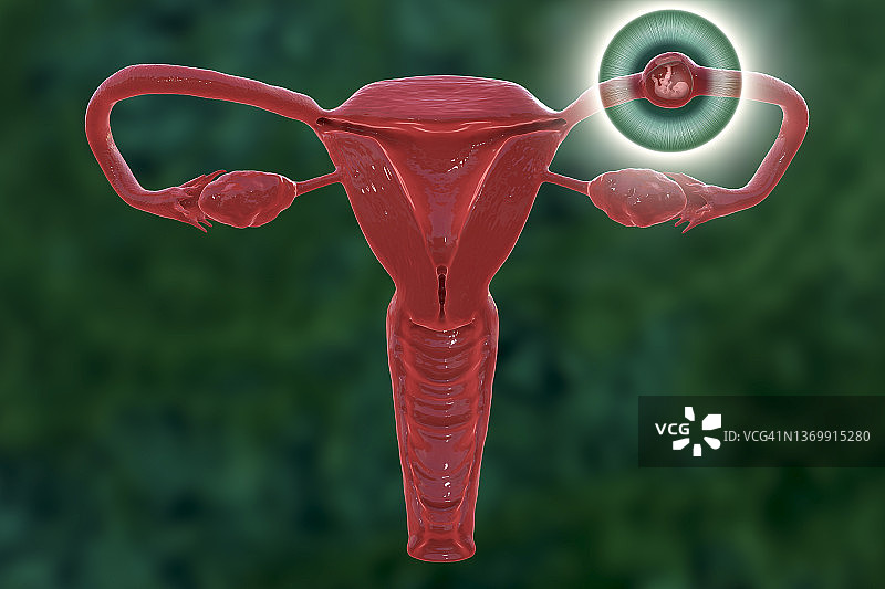 异位妊娠插图图片素材