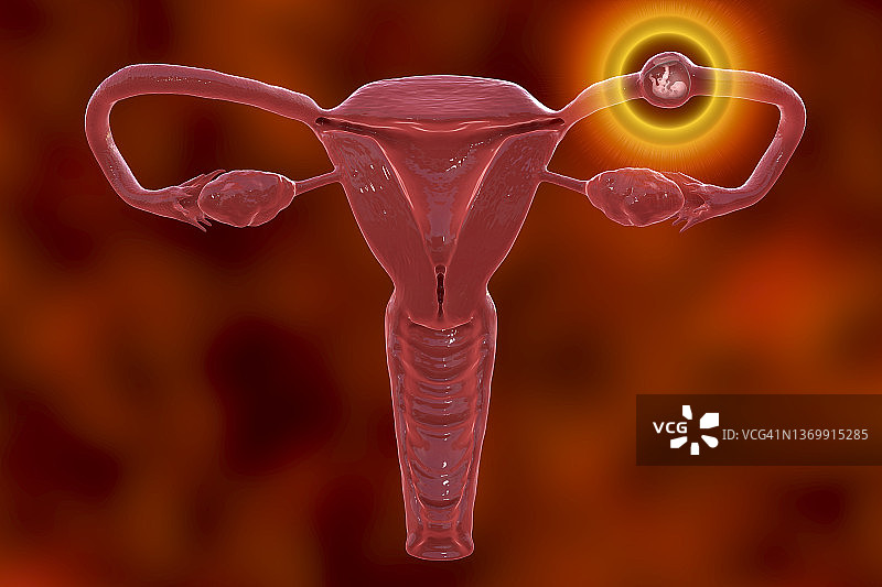 异位妊娠插图图片素材