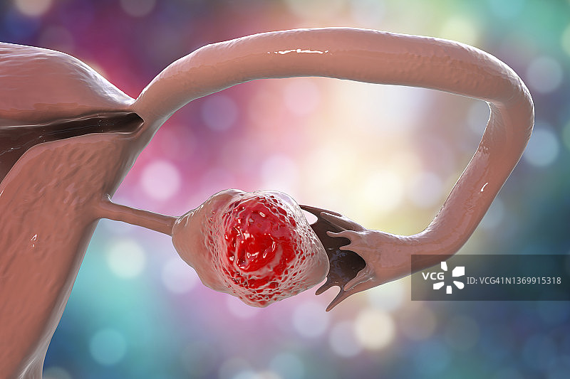 卵巢癌插图图片素材