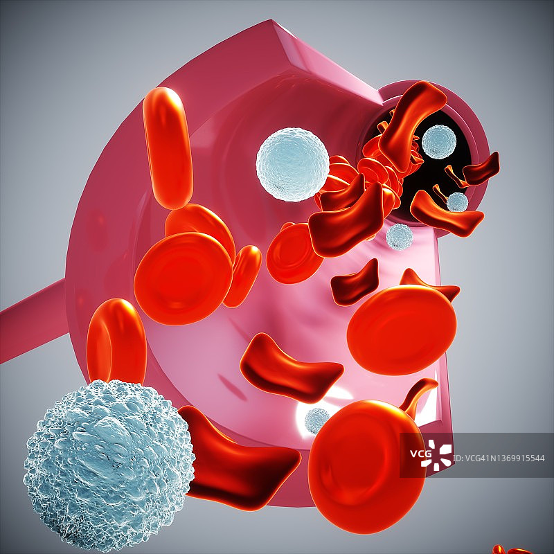 地中海贫血症图示图片素材