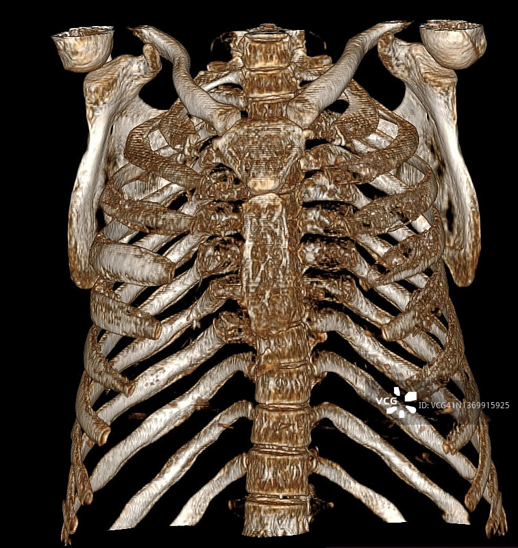 髓外造血，3D CT扫描图片素材