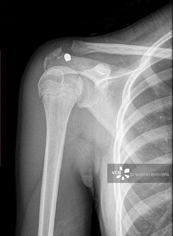 肩部枪伤X光片图片素材
