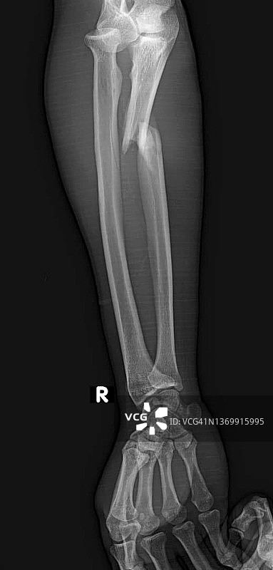 蒙特吉亚骨折X光片图片素材