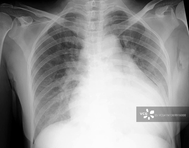 心脏扩大和肺水肿X光片图片素材