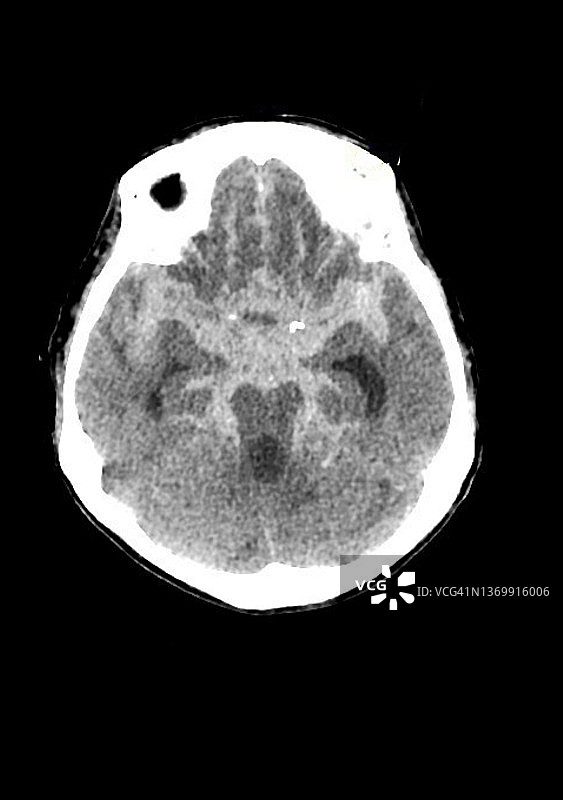 蛛网膜下腔出血CT扫描图片素材