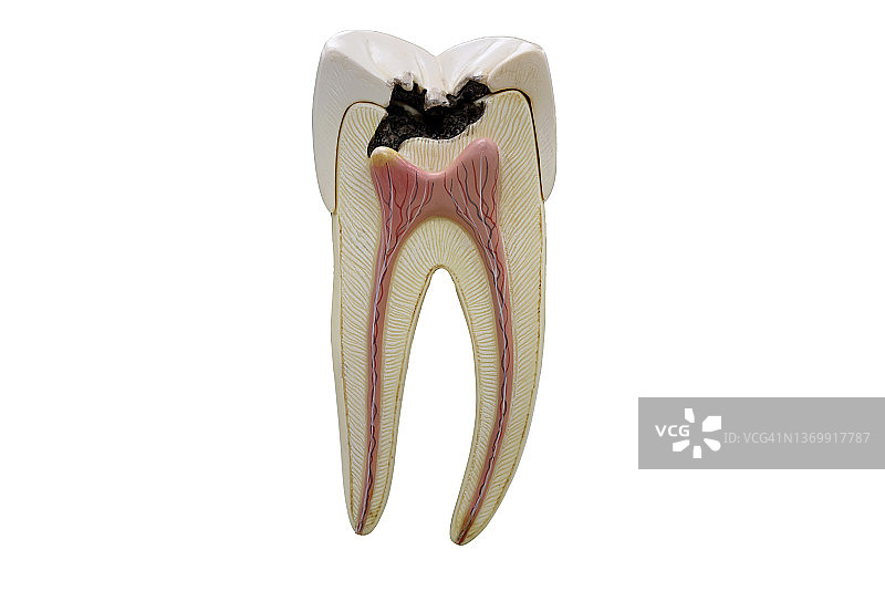 龋齿模型图片素材
