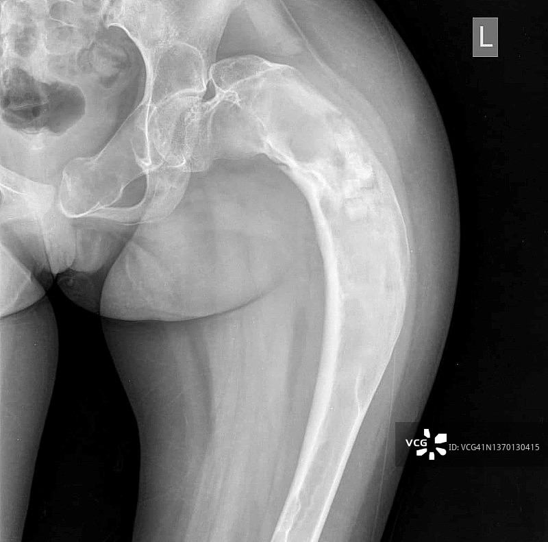 纤维结构不良X光片图片素材