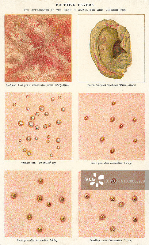老式彩色石印插图：皮肤疾病图片素材