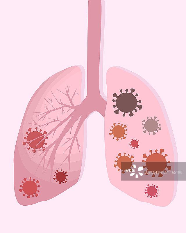 感染病毒或细菌的肺部矢量图图片素材