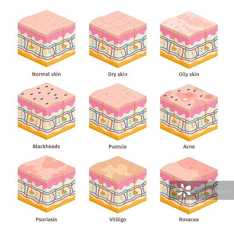 3D人体皮肤类型横截面图：干燥、油性和正常表皮图片素材
