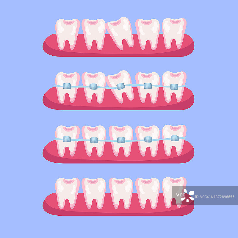 牙齿矫正前后卡通图图片素材