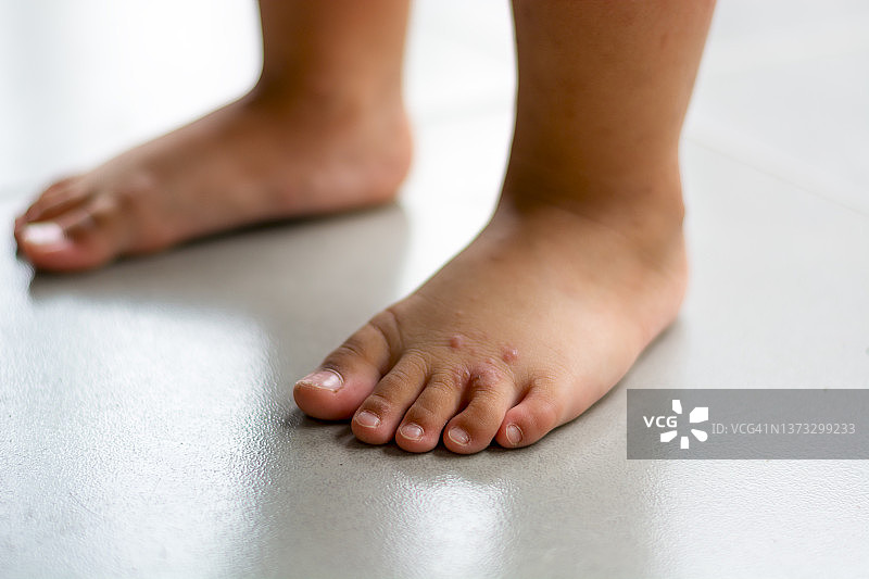 年轻女子脚部发痒，伴有红肿皮疹。瘙痒的可能原因包括足癣（真菌感染）、皮炎（湿疹）、牛皮癣或虫咬。健康护理。留白。图片素材