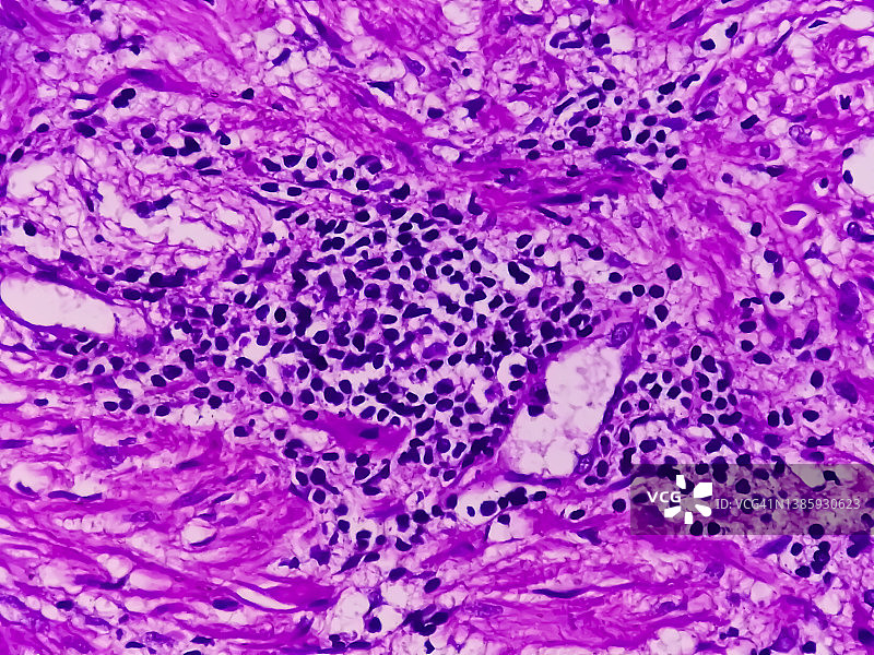 前列腺癌：前列腺组织、腺癌、恶性肿瘤、非典型上皮细胞的显微图像图片素材