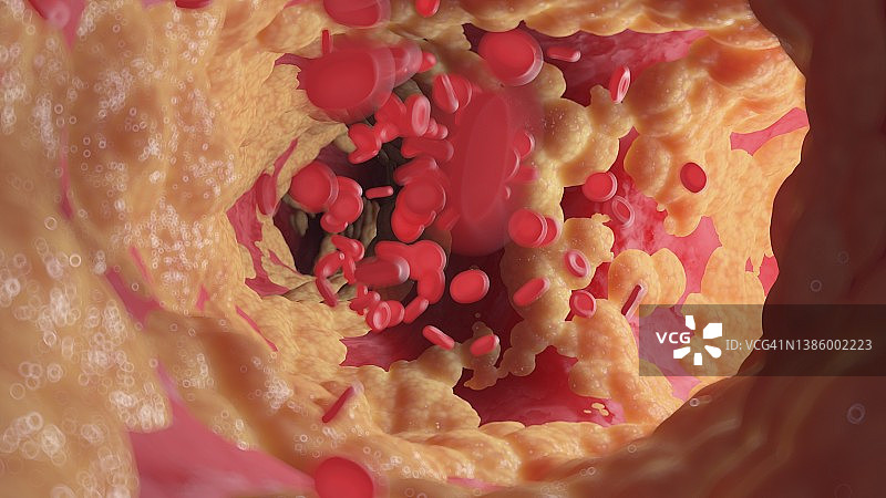人类脂肪动脉示意图图片素材