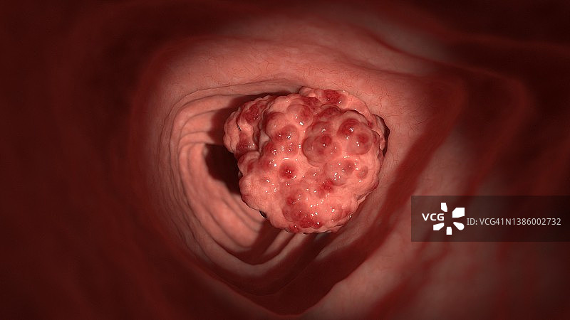 结肠肿瘤插图图片素材