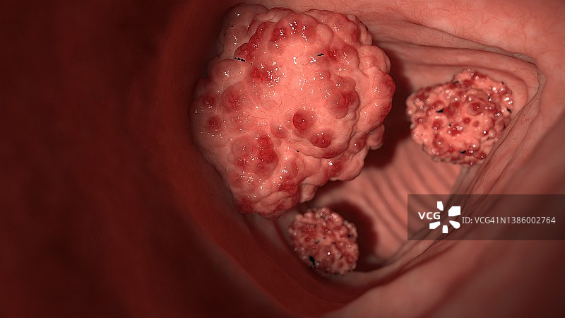 结肠肿瘤插图图片素材
