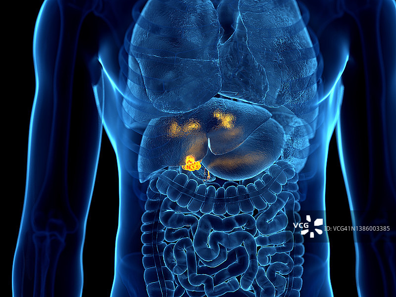 胆囊癌插画图片素材