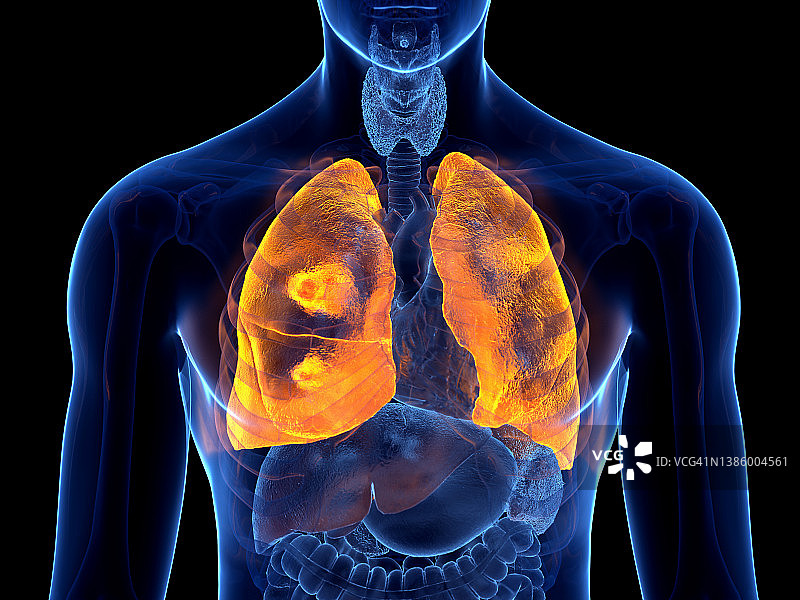 肺癌插图图片素材